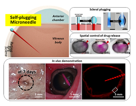 Development of self-plugging microneedle (SPM) for intravitreal drug delivery (2022.02.22) 